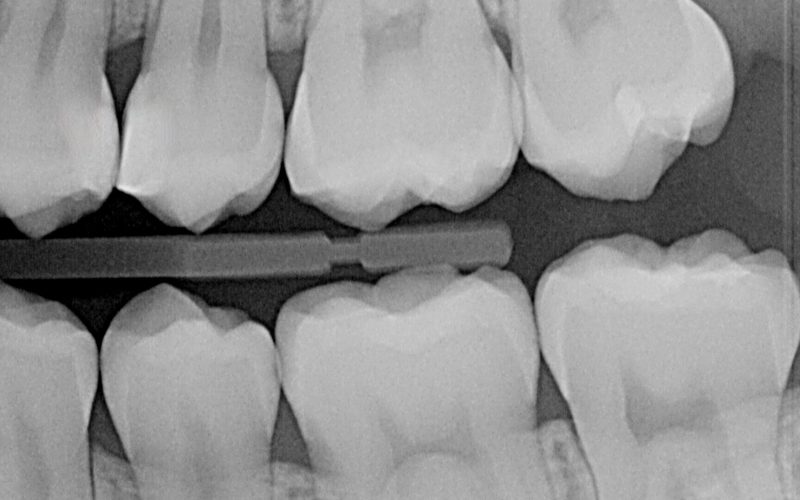 1 bis) immagine secondo caso clinico cariologia