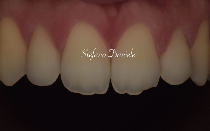 2) Odontoiatria conservativa anteriore