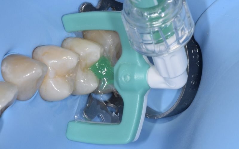 2 bis) immagine secondo caso clinico cariologia JPG