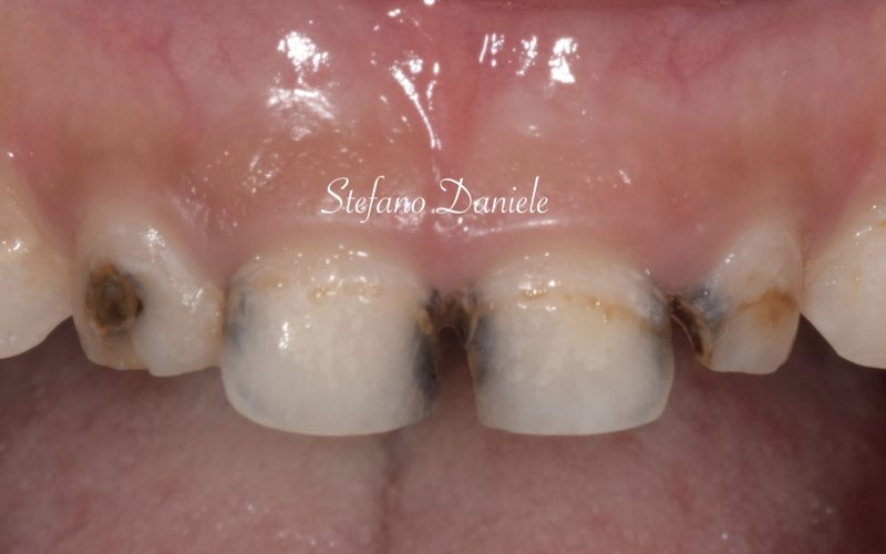 3) Immagine cariologia