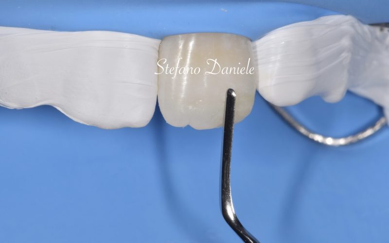 3) Odontoiatria conservativa anteriore
