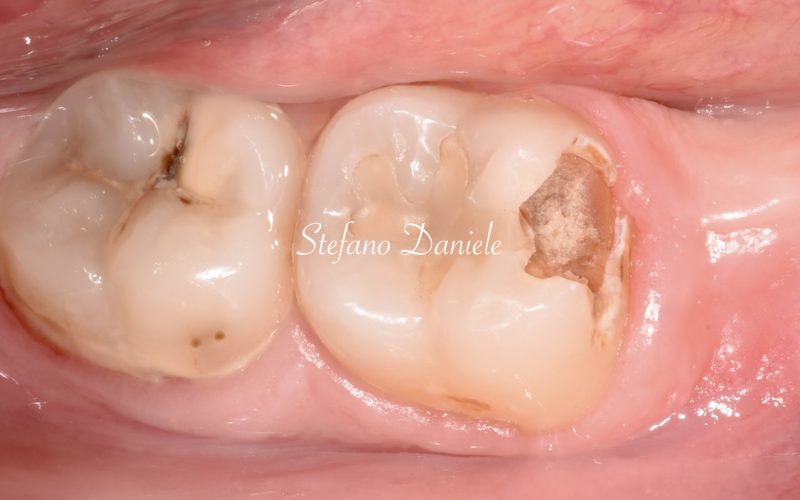 4) Immagine cariologia