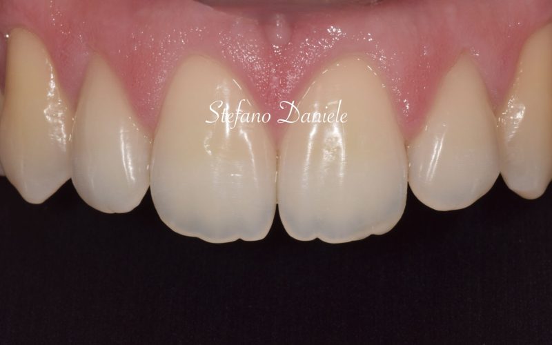 4) Odontoiatrai conservativa anteriore JPG