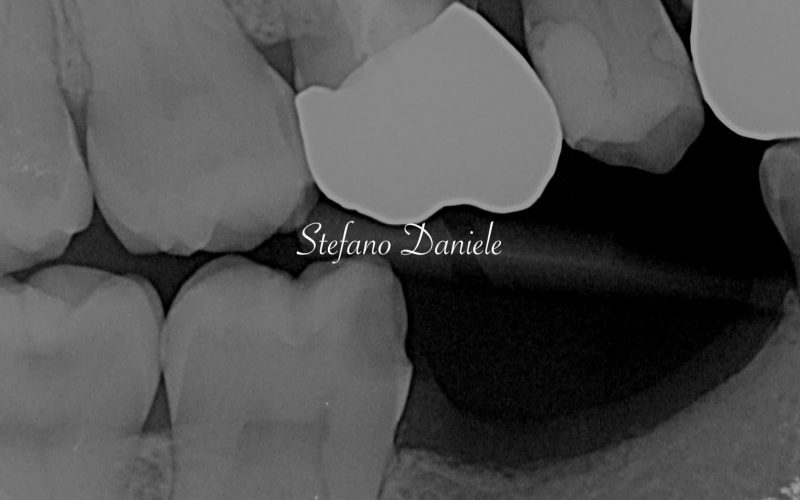 5) Immagine cariologia peg