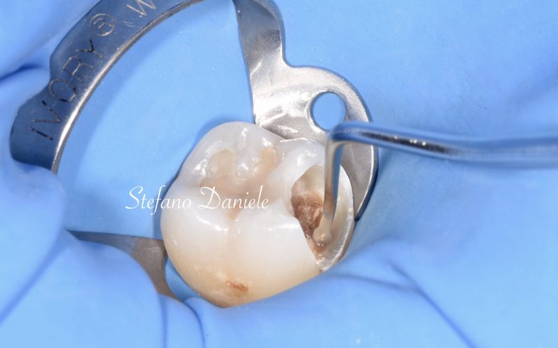 6) Immagine cariologia