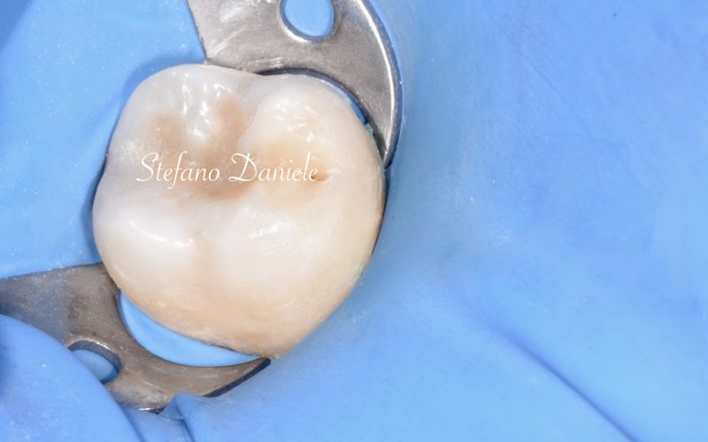 8) Immagine cariologia